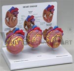 Mini Heart Set Models